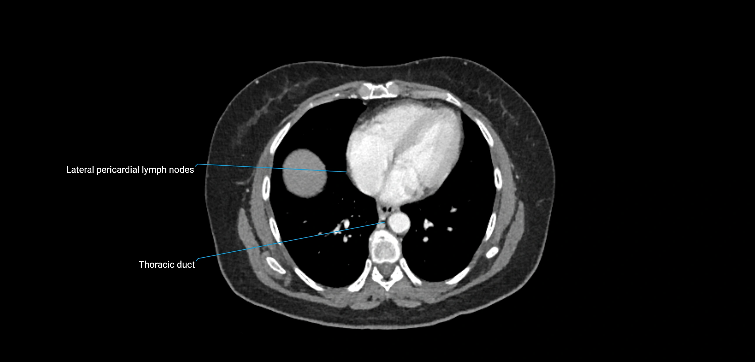 CT ct abdominal lymph nodes  axial cross sectional anatomy  enchanced radiology image -img-00002-00048.webp